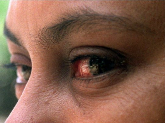 Cifra de Infectados por conjuntivitis crece a 51 mil en todo el país