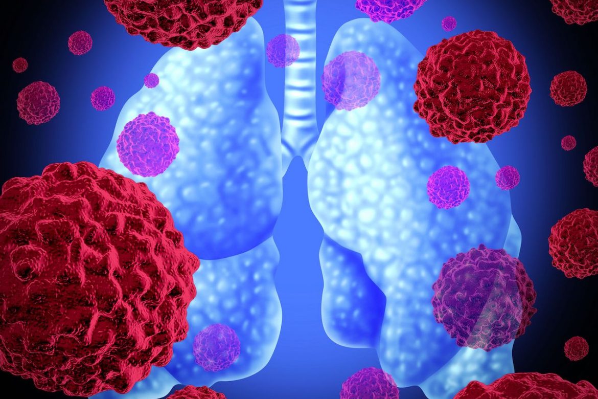 Dos innovadores tratamientos se convierten en nueva esperanza para pacientes con cáncer de pulmón