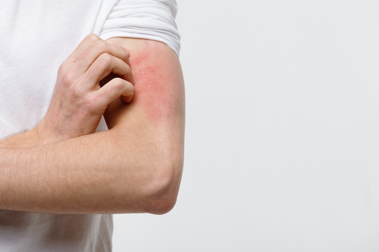 Diversos factores desencadenan la dermatitis atópica, el estrés es uno de ellos