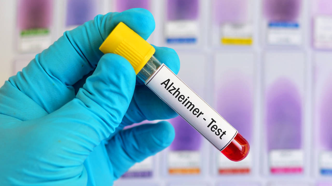 Científicos desarrollan test de sangre que detecta el alzhéimer en un 95%