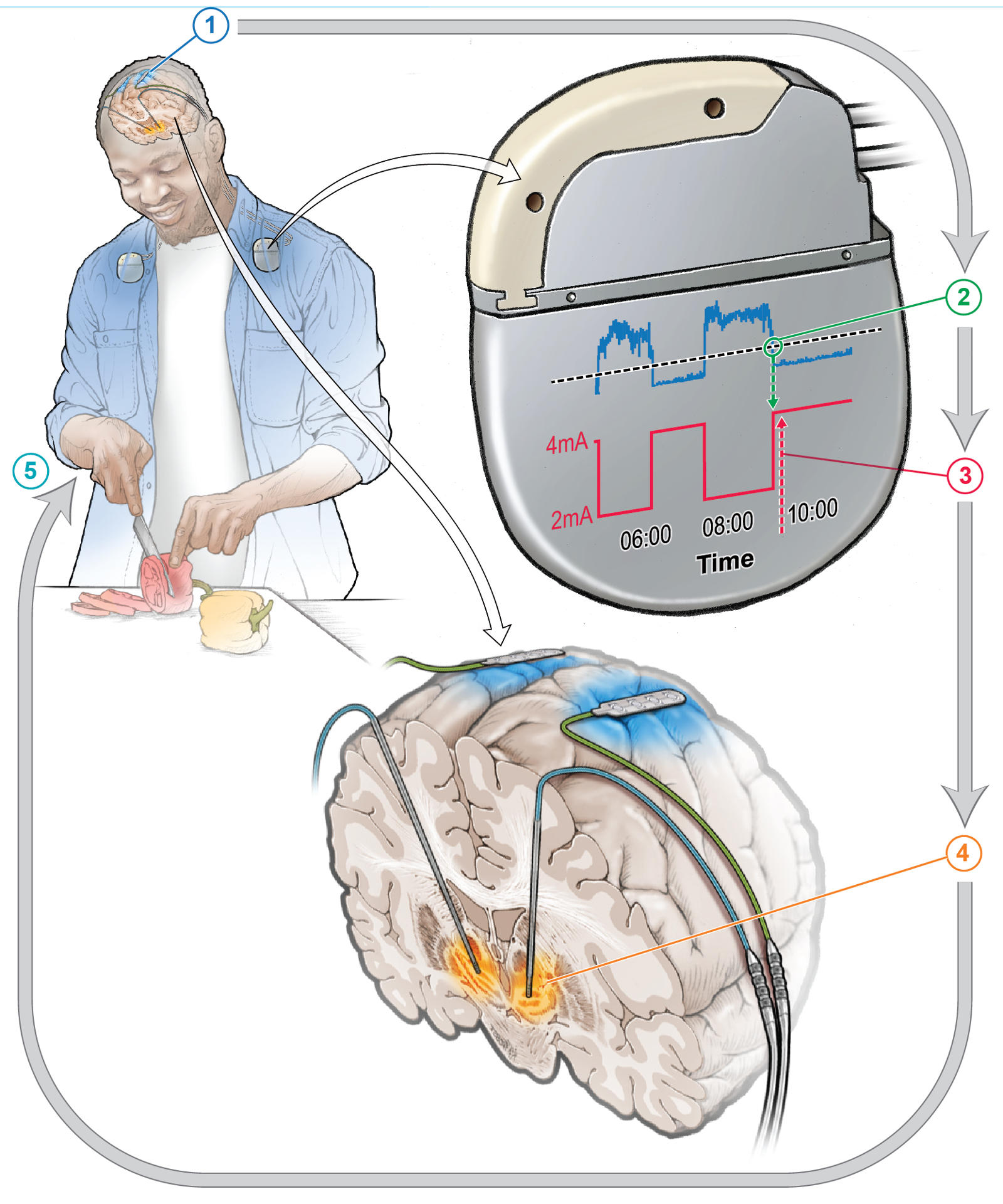 Desarrollan dispositivo para reducir los síntomas en pacientes con Parkinson