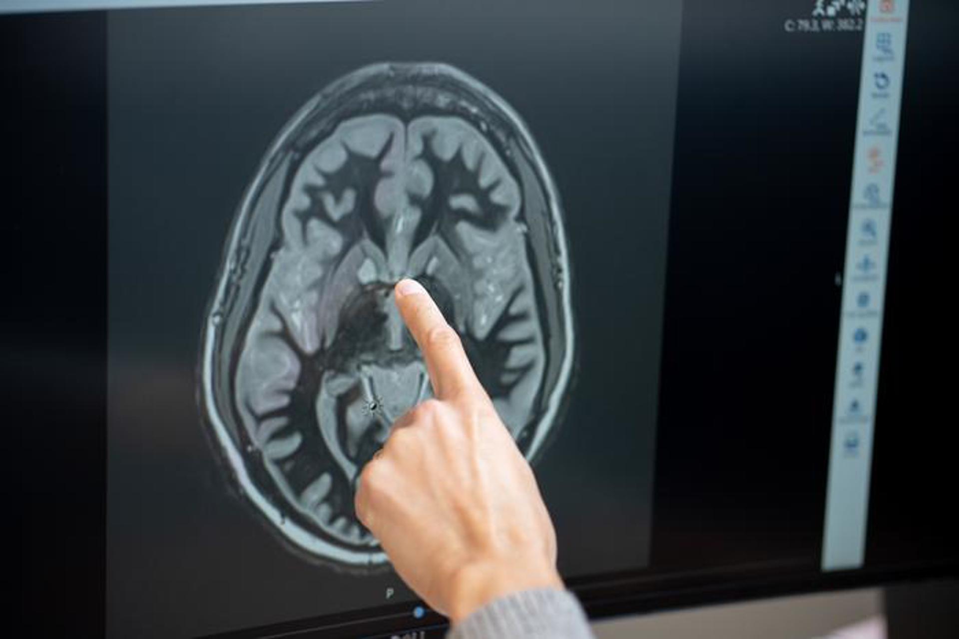 Logran medir actividad cerebral de una paciente tratada con fármaco antiobesidad