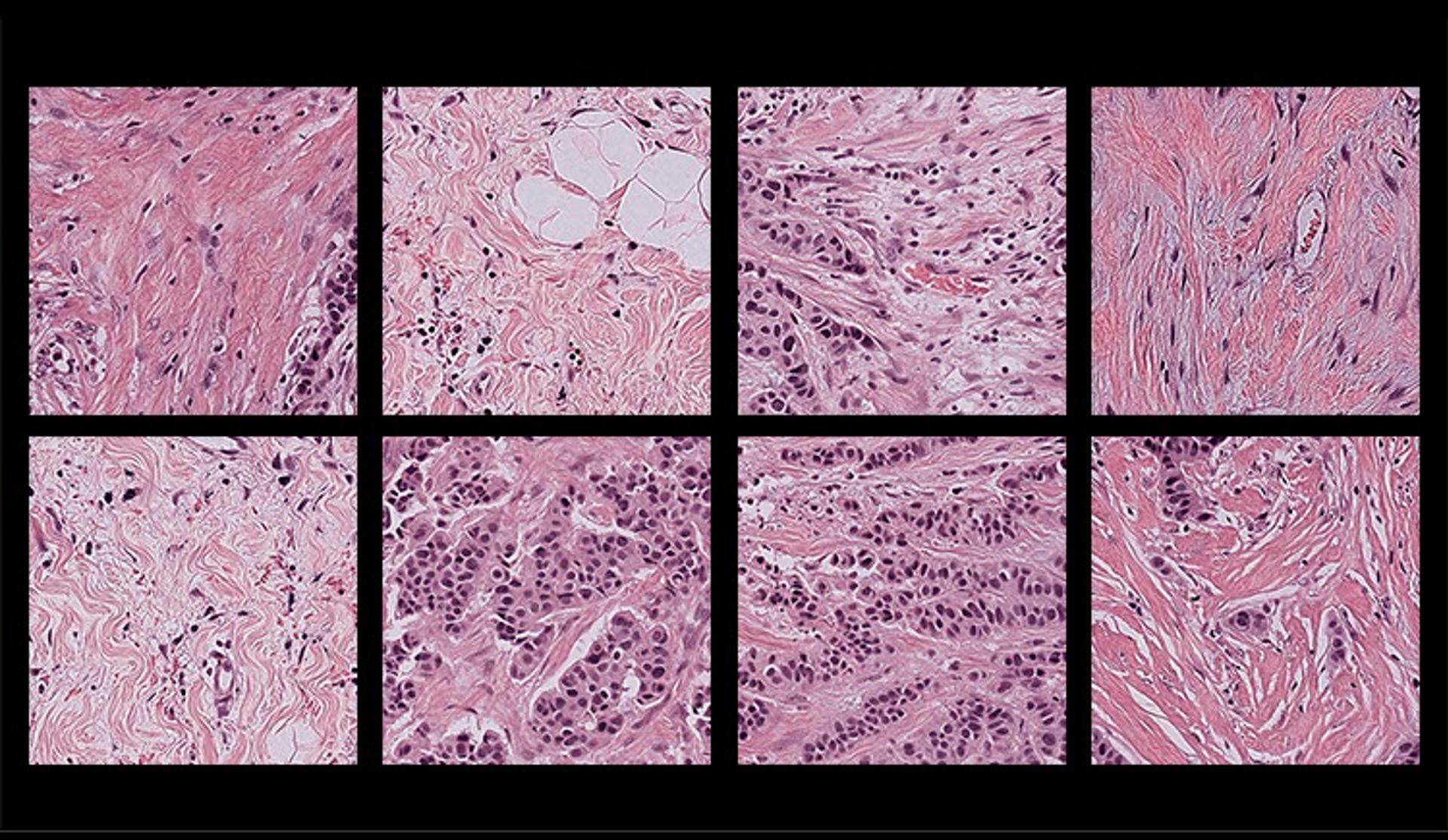 Nueva herramienta reduce el sesgo de los análisis patológicos con Inteligencia Artificial