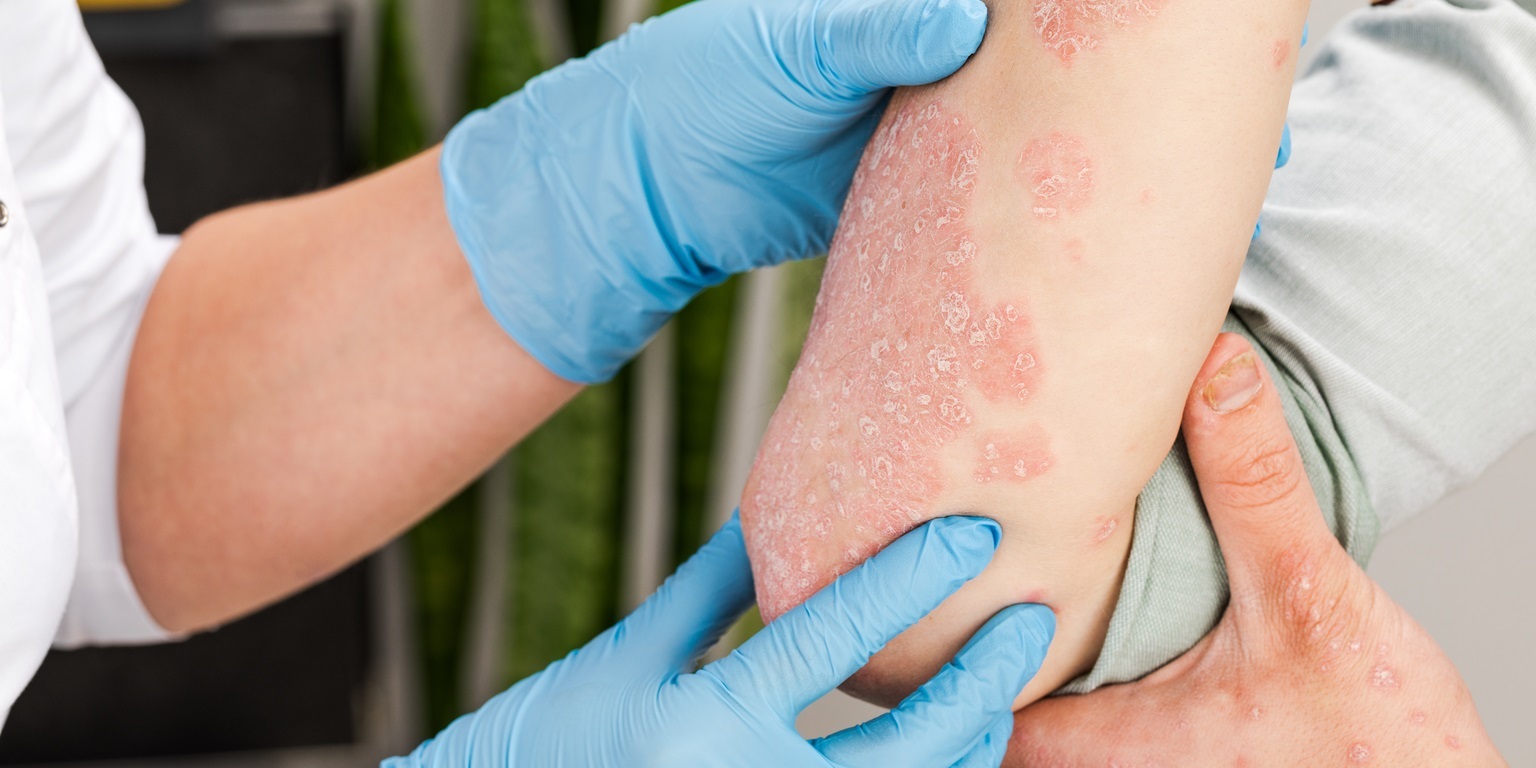 Especialistas alertan sobre la gravedad de la psoriasis pustulosa generalizada