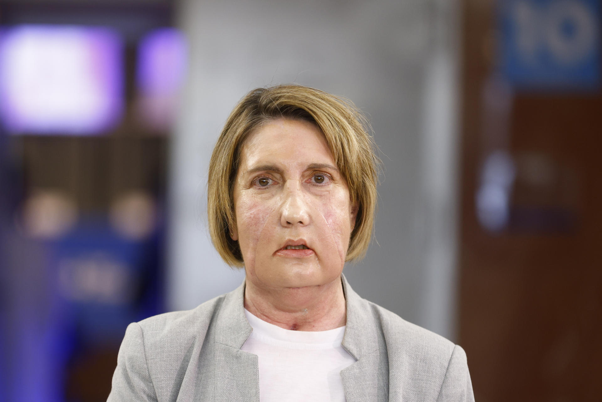 Hospital de Barcelona hace primer trasplante de cara del mundo con donante de eutanasia