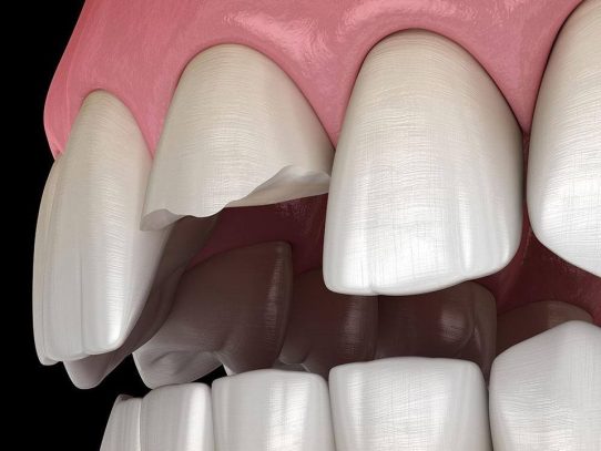 Los dentistas enfrentan una epidemia de dientes rotos. ¿Qué está pasando?