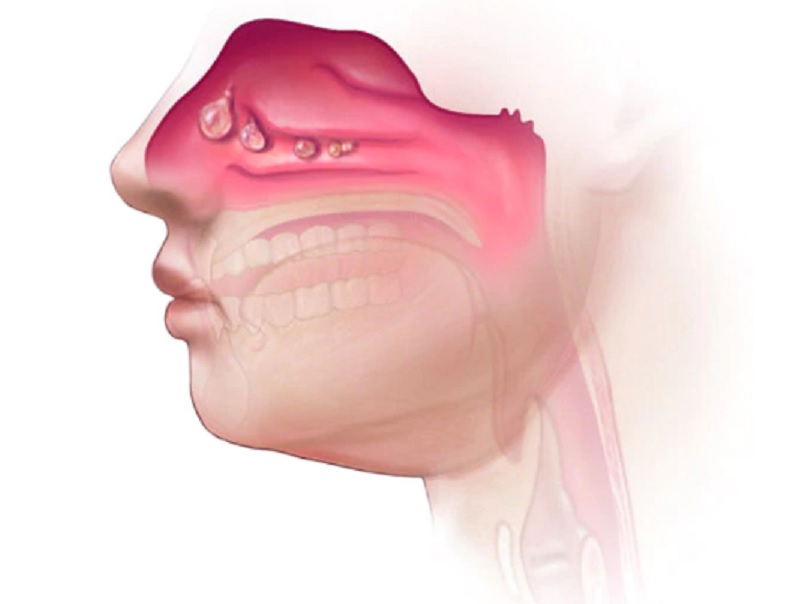 ¿Cuál es la causa de los pólipos nasales? ¿Hay que extirparlos siempre? ¿Pueden reaparecer?