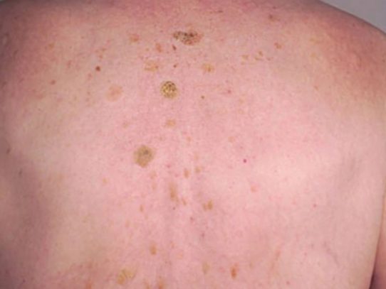 La queratosis seborreica no aumenta el riesgo para cáncer de piel