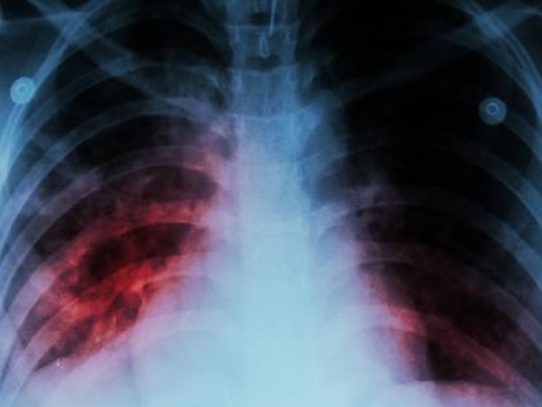 Minsa reporta dos casos de médicos residentes en el HST afectados con tuberculosis