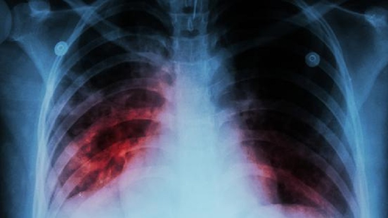 Minsa reporta dos casos de médicos residentes en el HST afectados con tuberculosis